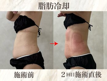 ウィボーテ(We Beaute)/【痩身】脂肪冷却×脂肪分解