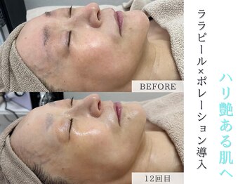 プルチャームエクイデム(Pulchram equidem)/ララピール+ポレーションで育肌