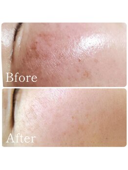 MMK/ハーブピーリングで透明肌へ