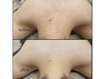 シュバル(CHEVAL)/背中うなじ脱毛ビフォーアフター
