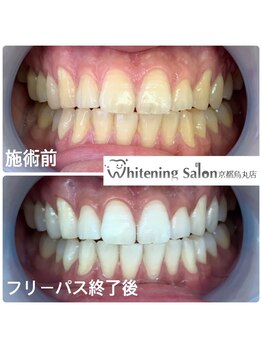ホワイトニングサロン 京都烏丸店/ホワイトニング施術例
