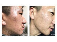 マリール ビィヴィ(Marire Bivi)/リベルハーブピーリング