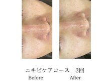 メンズミーシェ(Men's Meshie)/毛穴大洗浄エステ施術後