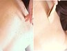 【背中上部▼ニキビケア】もみほぐし+剥離なしピーリング+ニキビケアWパック