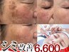 【シミ改善No.1】 シミ集中改善50分(個数・大きさ無制限)頭皮マッサージ付