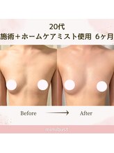 ミミバスト(mimibust)/バストアップBeforeAfter