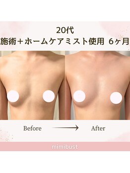 ミミバスト(mimibust)/バストアップBeforeAfter