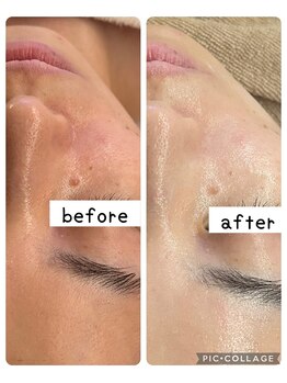 ルピナージュ(Lupinage)/【肌質改善】-毛穴/しみケア-