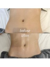 グレアージュ(GLEAGE)/全身痩身凹凸脂肪コース！