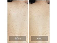 ルナート(Lunart)/ハーブピーリング【背中】