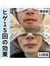 【痛くて我慢できなかった方向け】初回カウンセリング＋ヒゲ脱毛1回¥5900
