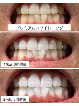 ホワイトニングビューティ 三川店/before　after