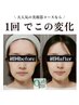 【小顔矯正+美肌美顔器8回モニターコース】 通常79,200円→モニター44,000円