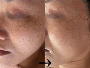 サロン ドロップ 上小田井(Salon drop)/「シミ改善」