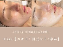 シーヴォーク(Cveauque)/ハーブピーリング｜ハーブリプロ