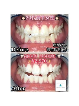 ホワイトニングビューティー 松戸店(Whitening Beauty)/ビフォーアフター