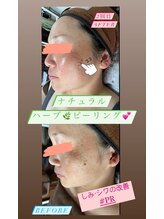 セレニティー(serenity)/しみ・シワに働きかけるハーブ