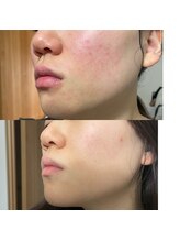 ミーツ(MEETS)/肌荒れ徹底改善　右