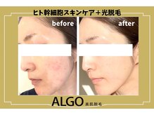 アルゴ 山口宇部店(ALGO)/ヒト幹細胞スキンケア×光脱毛