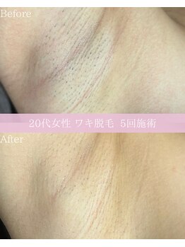 ソルーナ(SOLUNA)/ワキ脱毛5回目ビフォアフ