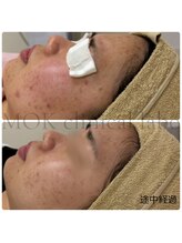 ナビ(NAVI)/ニキビケア赤み鎮静／SOS肌管理