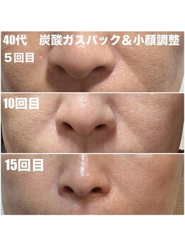 太陽と月/炭酸ガスパック&全身リンパ