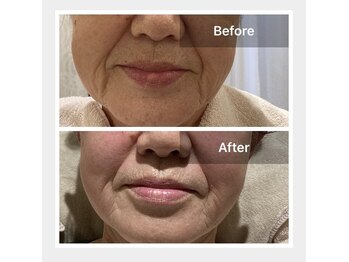 ラベージャ(La Bella)/ヒト幹細胞エステ