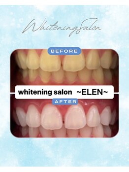 エレン 高槻店(ELEN)/ 垢抜けするならホワイトニング
