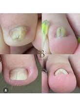 ベルタネイル(BELTA NAIL)/巻いた爪