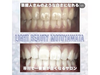 ライトビューティー 本八幡店(LIGHT BEAUTY)/ホワイトバンドのある歯も!