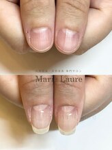 マリーロール 梅田店(Marie Laure)/深爪矯正/自爪育成/自爪風