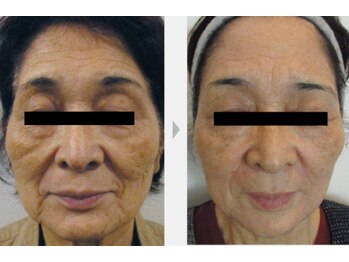 Nビューティー/最新RFサーモシェイプオーパス