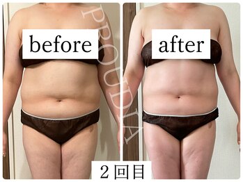 プラウディア(PROUDIA)/痩身エステ／ダイエットエステ