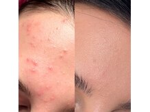 大宮フェイシャルエステ/顔脱毛/ニキビケア/毛穴ケア/たるみ改善