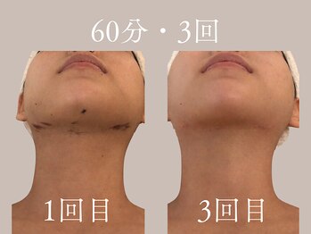 ハネ 自由が丘(Hane)/[自由が丘/インディバ/術後ケア]