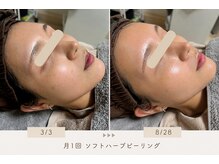 ハル(Halu)/ソフトハーブ継続6ヶ月