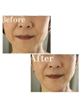 リプロ(RE:PRO)/小顔むくみ撃退コース