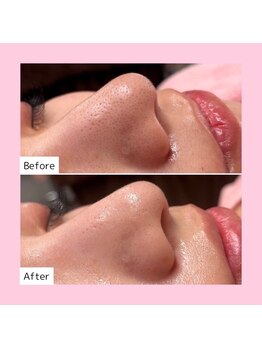 ホワイトラボ 岸和田店(White labo)/【施術例】ハイドロ毛穴洗浄