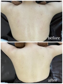 ジャスミン(Jasmin)/背中ニキビ・毛穴ケア