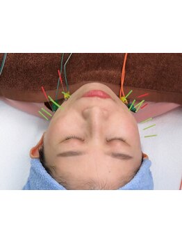 鍼灸施術を受けたい