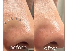 サロンアンドビューティ エス チャタン(Salon＆Beauty S chatan)/ハイドロ毛穴洗浄ピーリング