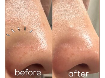 サロンアンドビューティ エス チャタン(Salon&Beauty S chatan)/ハイドロ毛穴洗浄ピーリング