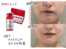 キレイベース 銀座店(KIREI BASE)/レッドショット　1回での変化