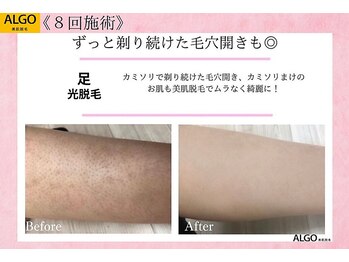 アルゴ 南茨木駅前店(ALGO)/【足】剃れば剃るほど汚肌に、、
