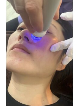 ケーエピ 長居(K-epi)/ハイドラ毛穴洗浄 1