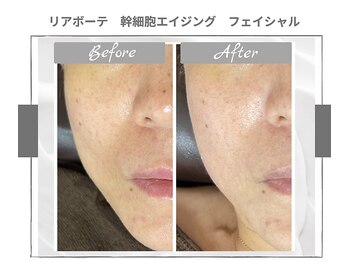 ラ ルーチェ 星田/幹細胞エイジング　フェイシャル