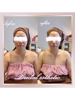 デジール(DESIR)/*ラジオ波フェイシャル90分*