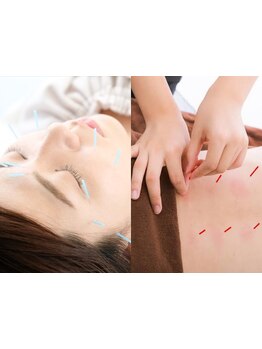 鍼灸施術を受けたい