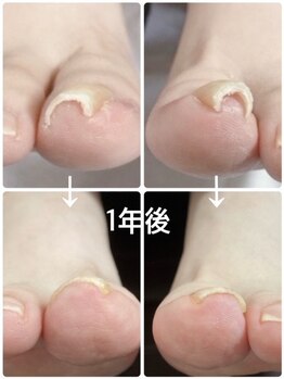 フロー(Froh)/浮きゆび顕著