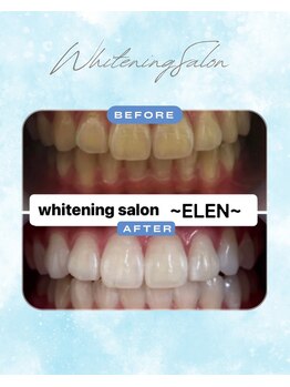 エレン 高槻店(ELEN)/ 白い歯手に入れませんか?